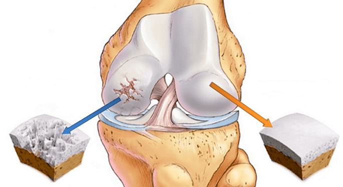 здаровы храсток і храсток уражаны артрозам